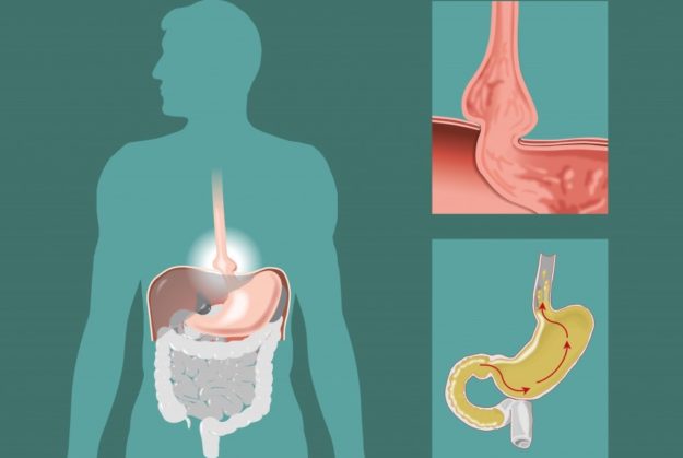 hernia-de-hiato hernia-de-hiato